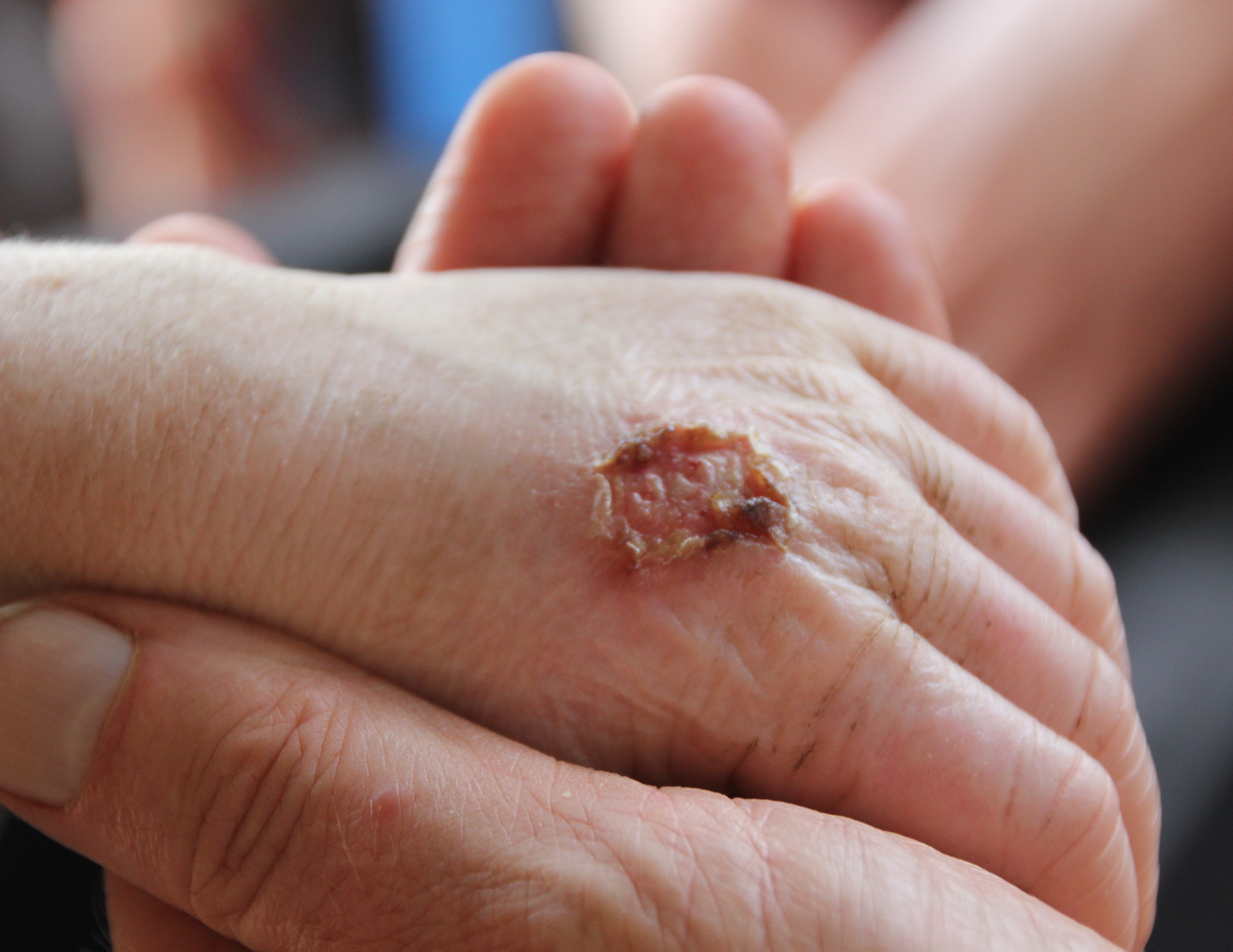 Hand of a child with albinism